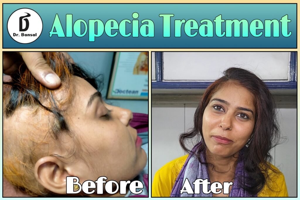 Ayurvedic Treatment For Hair Fall in Ghaziabad