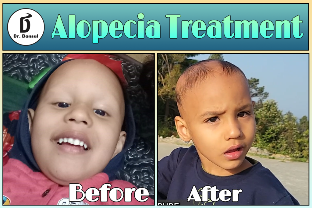 Hair Regrowth Clinic in Ghaziabad