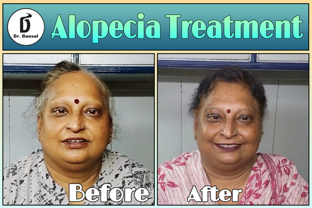 Best Medicine for Alopecia Areata