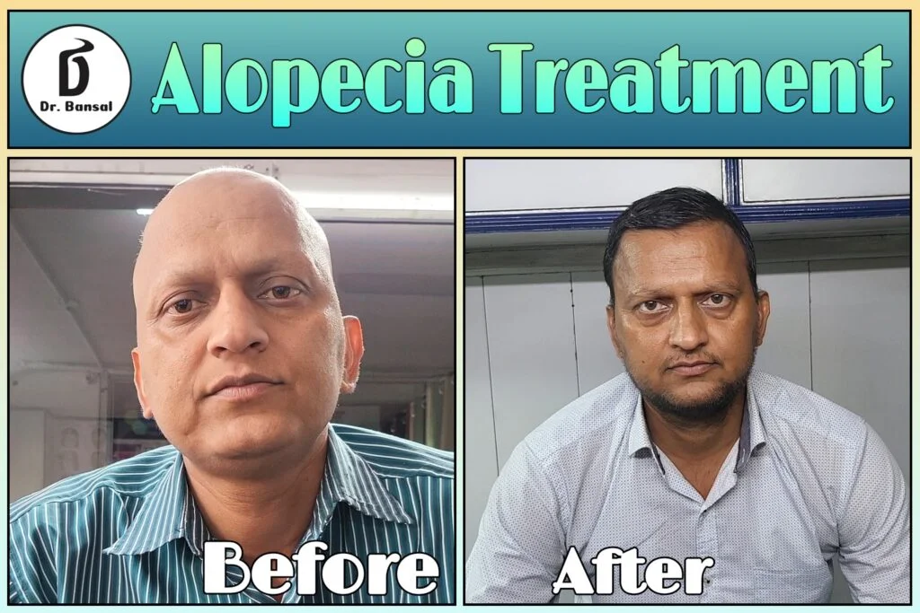 Best Alopecia Treatment In Ghaziabad