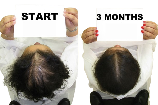 Best Doctor For Alopecia