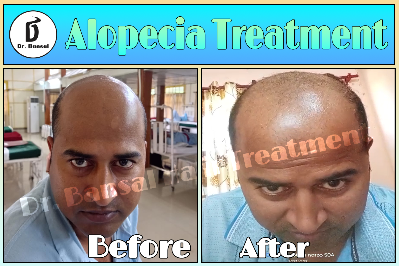 Male pattern baldness in India