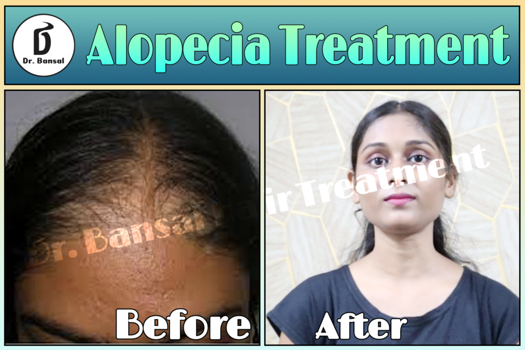 Male pattern baldness in India