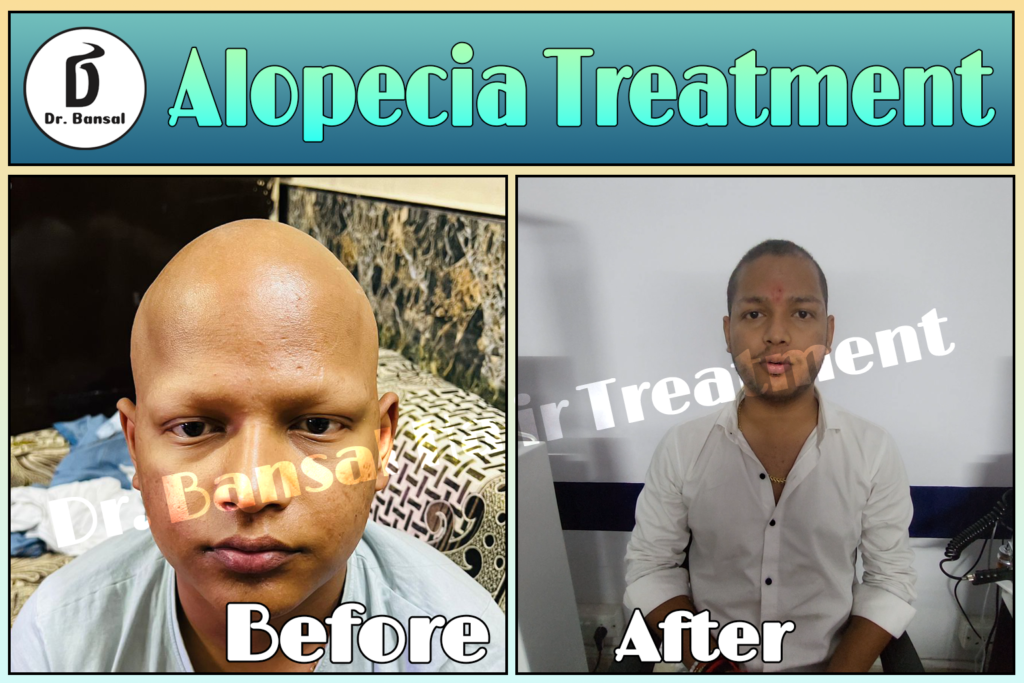 Natural Treatment for Alopecia Areata