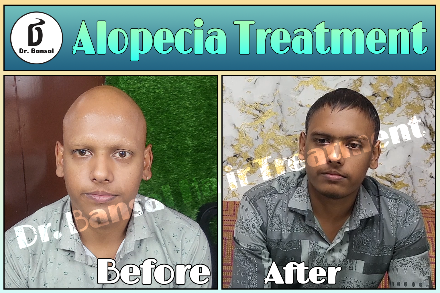 Hair Fall Solutions in Uttar Pradesh