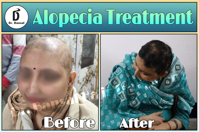 Alopecia Universalis Treatment In Ghaziabad