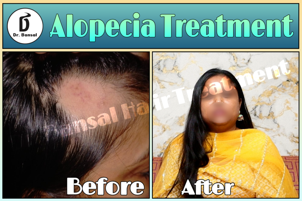 Regrow Hair Naturally In Ghaziabad