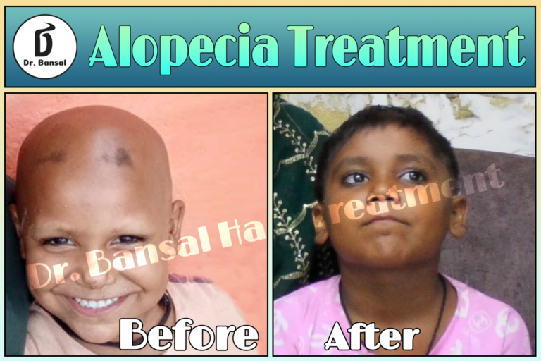 Regrow Hair Naturally In Ghaziabad