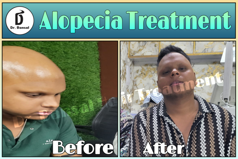 Alopecia Universalis Treatment In Ghaziabad