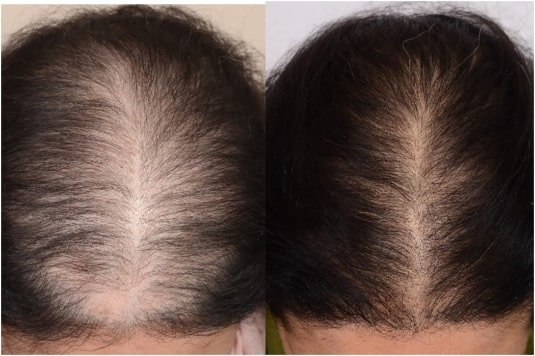 Best Hair Growth For Alopecia Areata