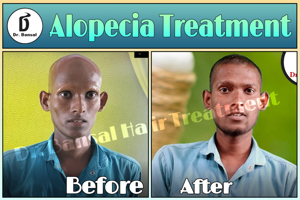 Alopecia Treatment