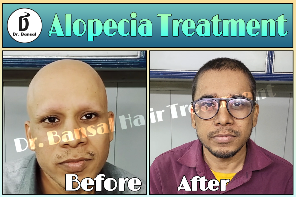 Hair Loss Treatment