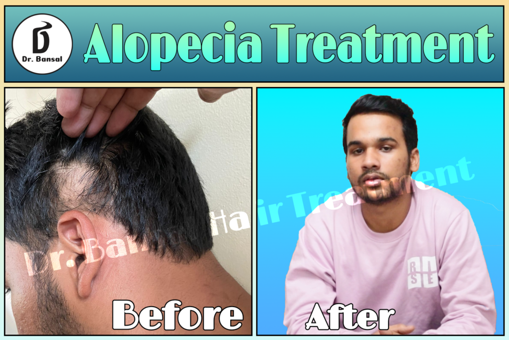 Alopecia Treatment