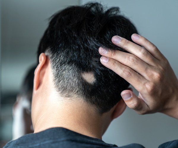 Patchy Hair Loss