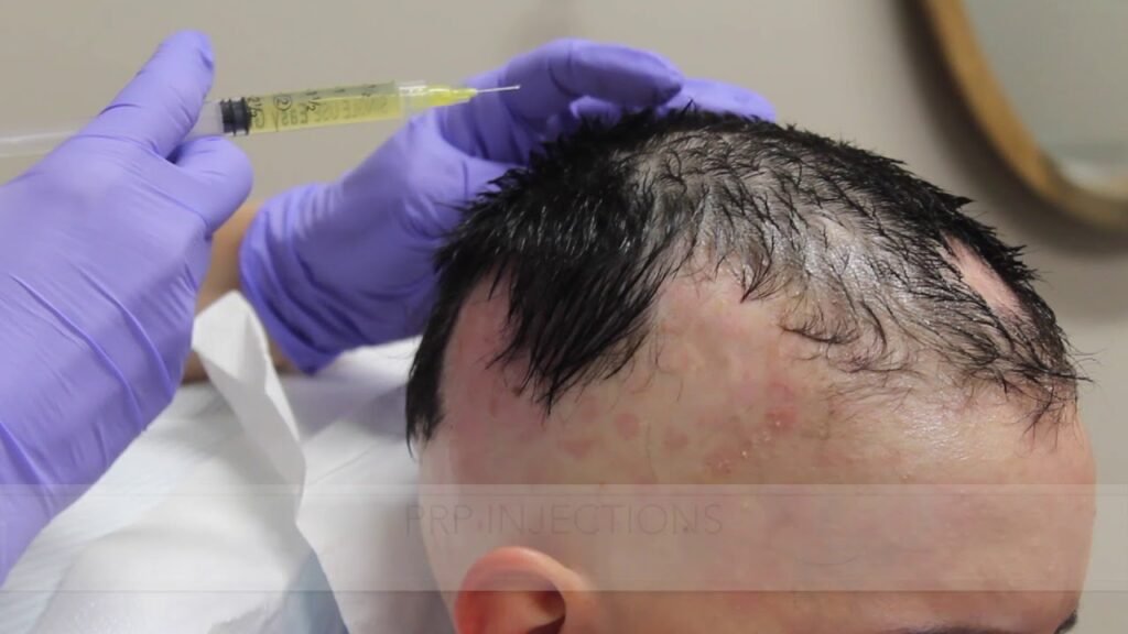 Alopecia Areata Natural Treatment