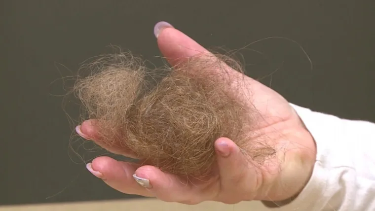 Hair Loss Doctor Ghaziabad