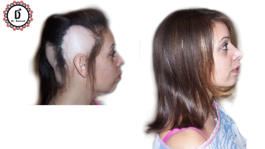 Permanent solution for Alopecia