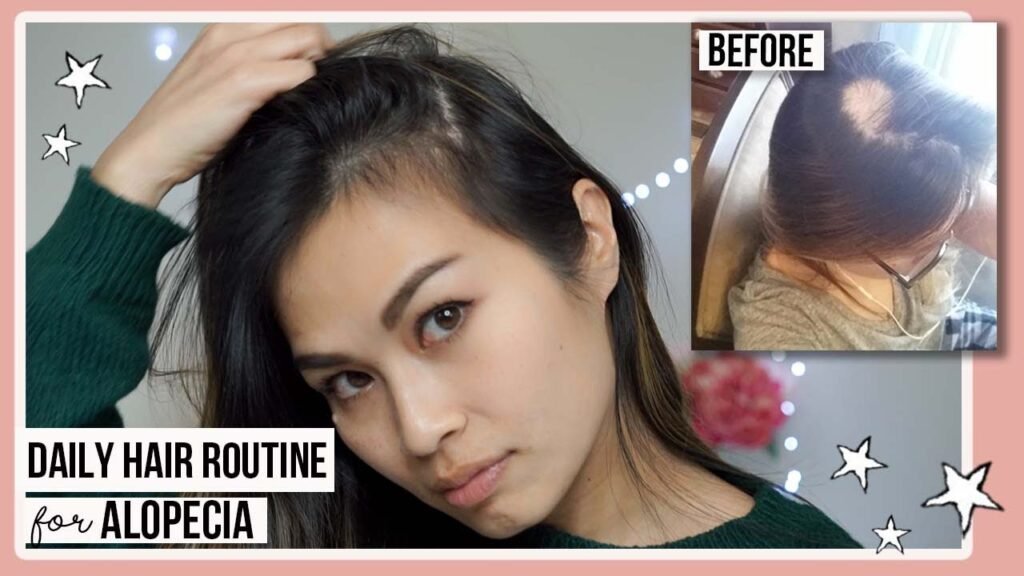 Alopecia Areata And Hair Loss