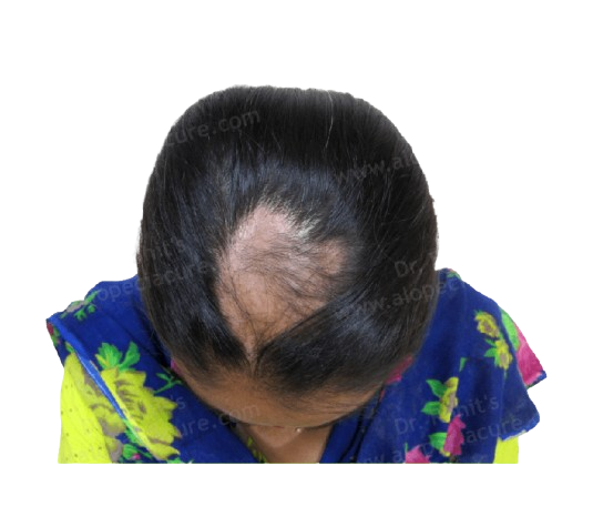 How To Stop Alopecia Areata
