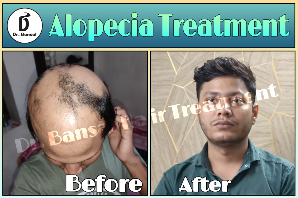 Autoimmune alopecia areata treatment