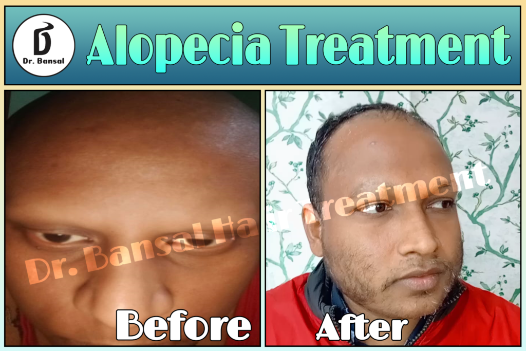 Regrow hair naturally