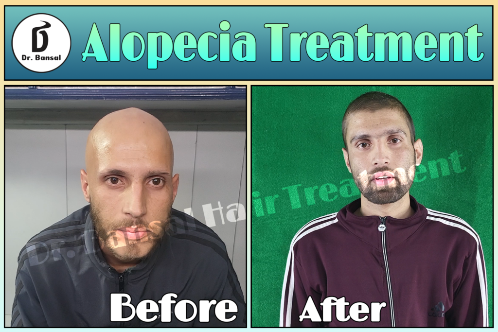 Best Hair Fall Treatment at Home