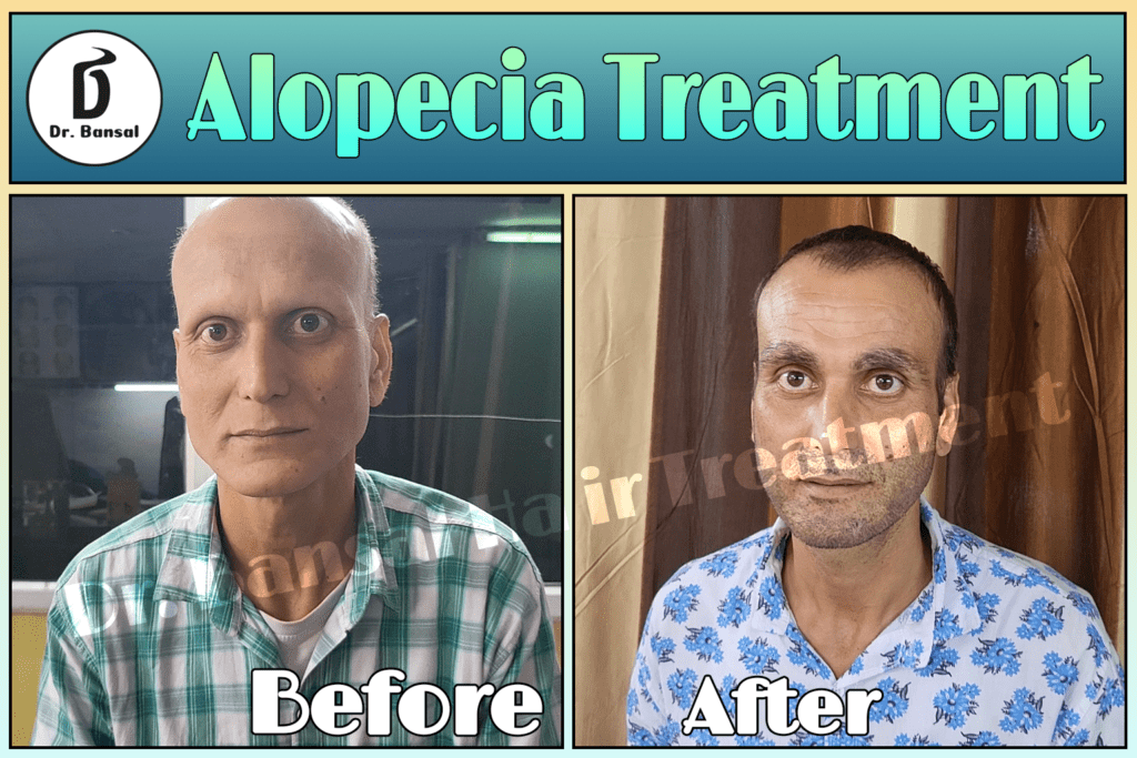 Alopecia treatment