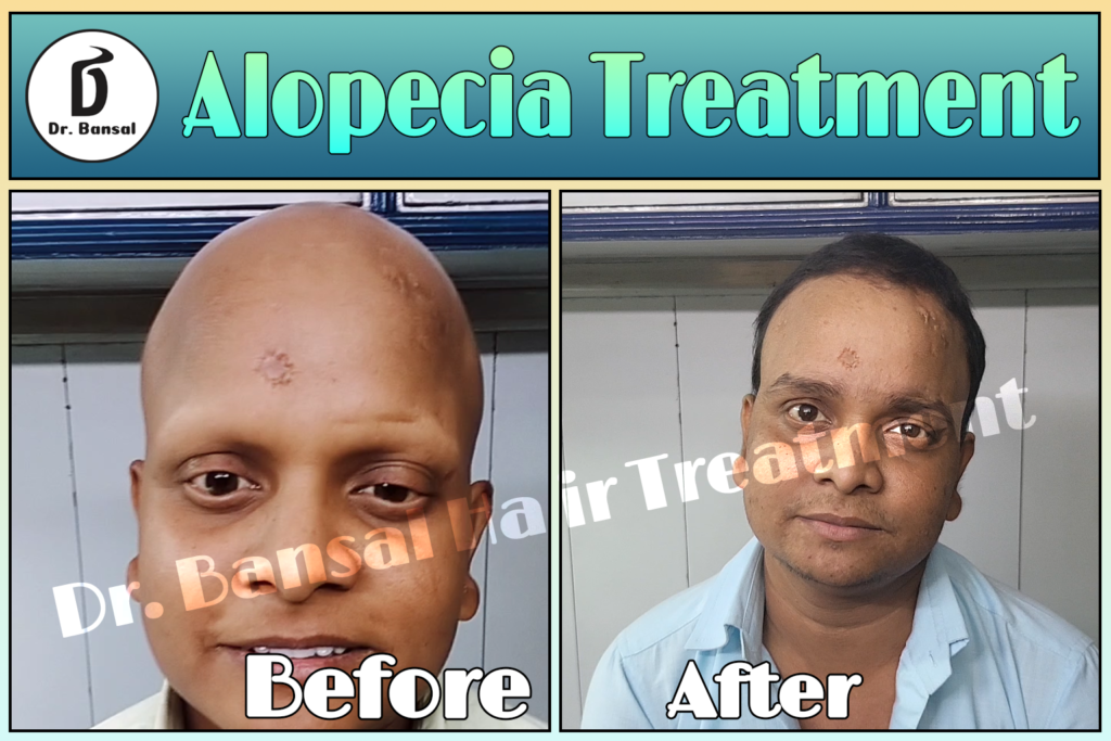 Top Alopecia Doctors in India