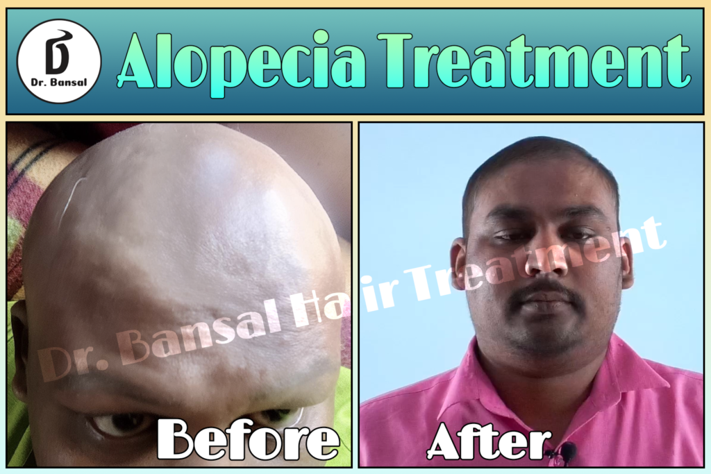 Best Solutions for Alopecia Areata