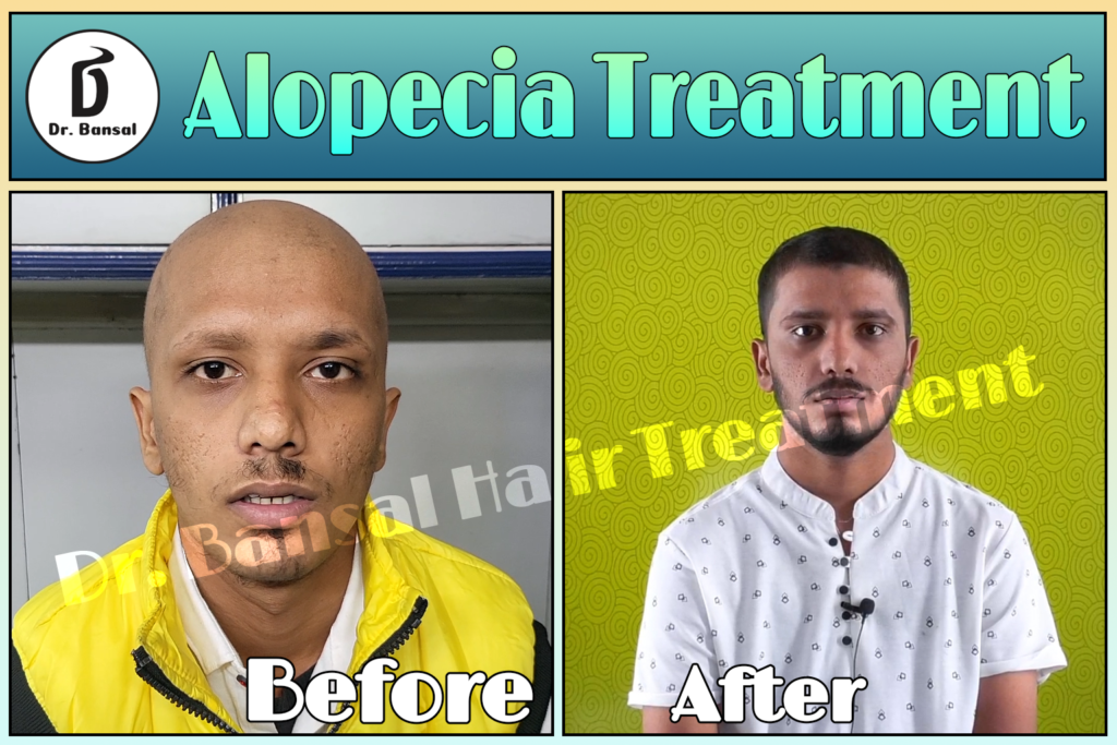 Regrow hair naturally