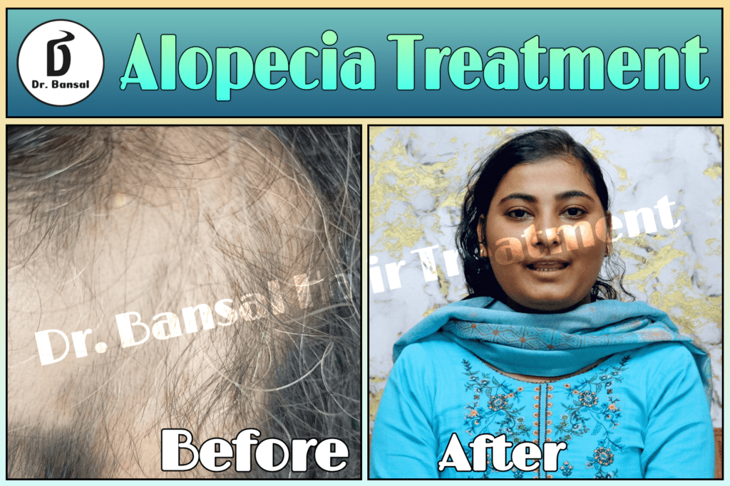 Alopecia treatment
