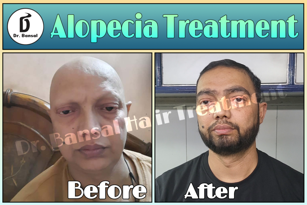 Stop hair fall In Ghaziabad