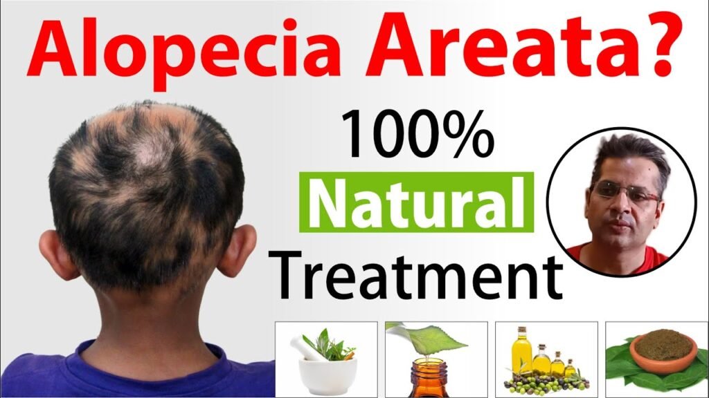 Natural Treatment for Alopecia Areata