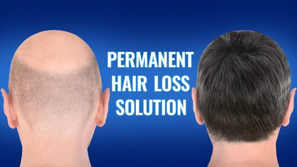 Permanent hair loss solutions