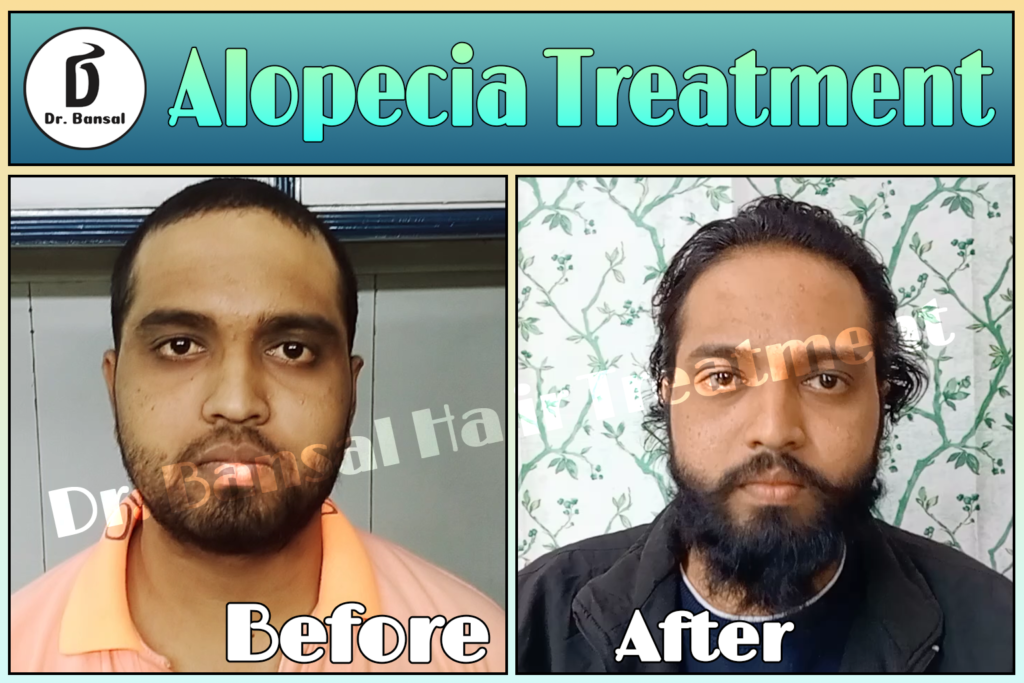 Alopecia treatment