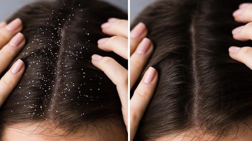 Dandruff and Hair Fall Treatment