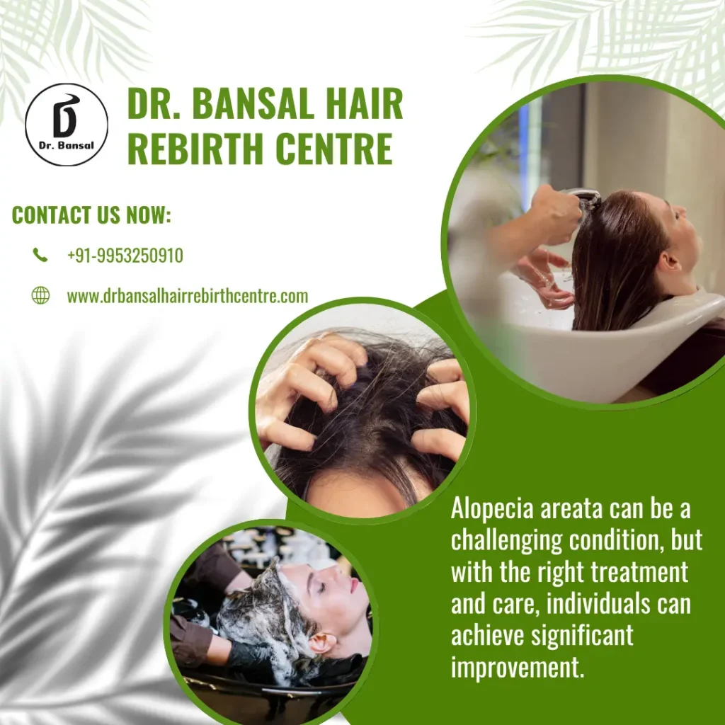 Best Doctor for Alopecia in India-Dr Bansal-1