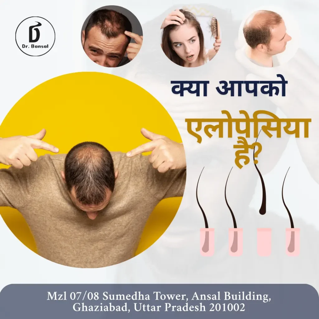 Best Alopecia Areta Treatment Doctors In Ghaziabad-Dr Bansal-1