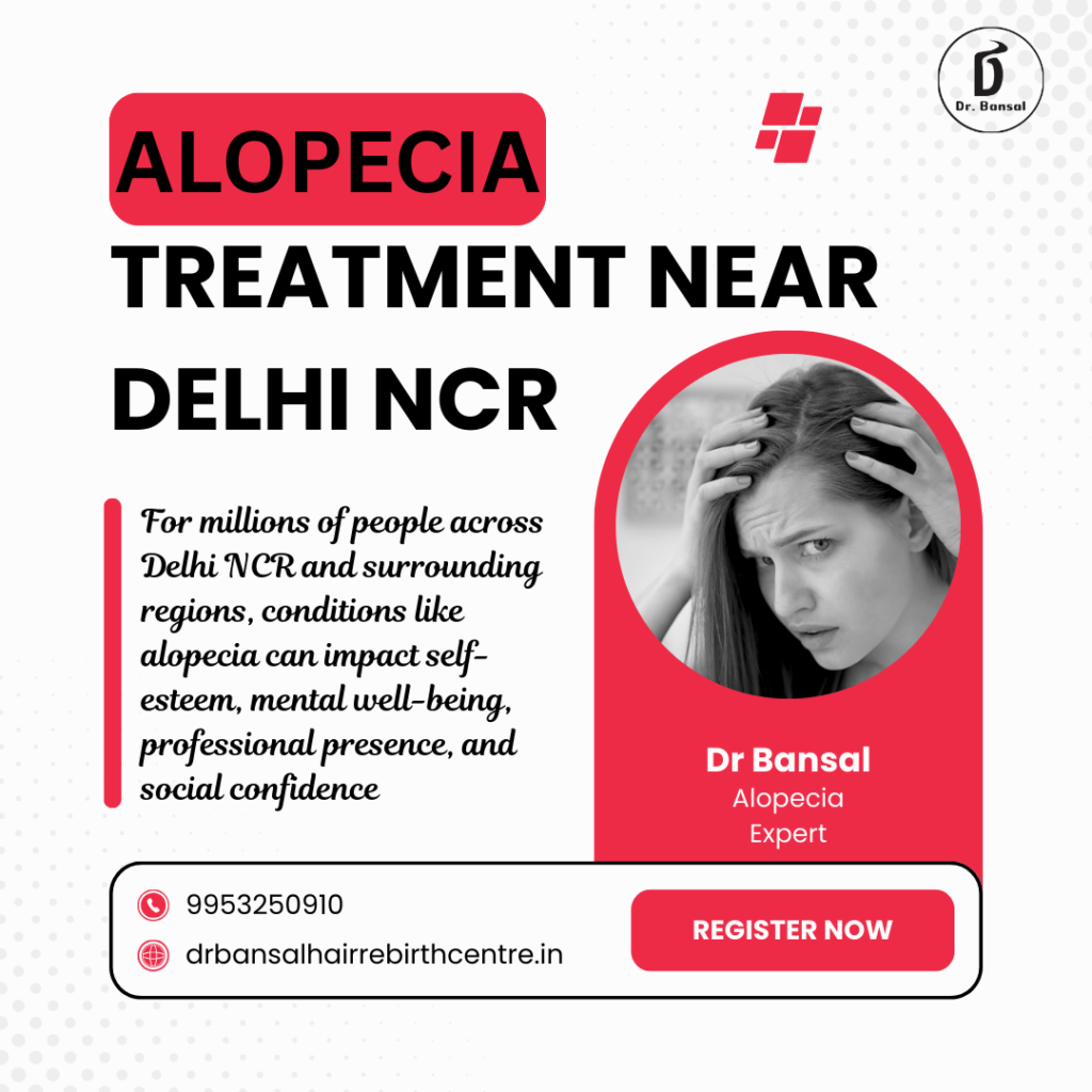 Alopecia Treatment Near Delhi NCR