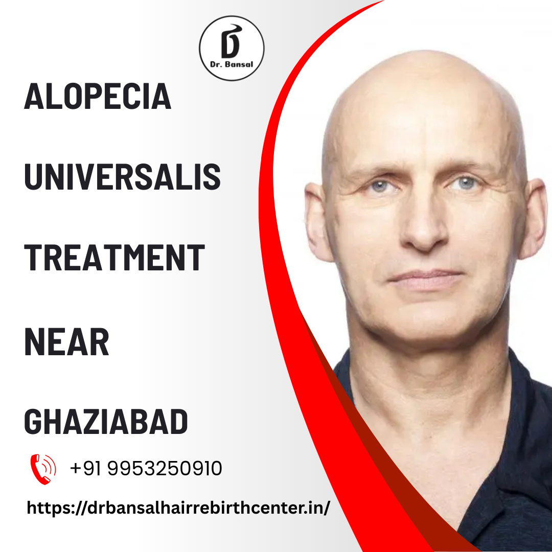 Alopecia Universalis Treatment Near Ghaziabad