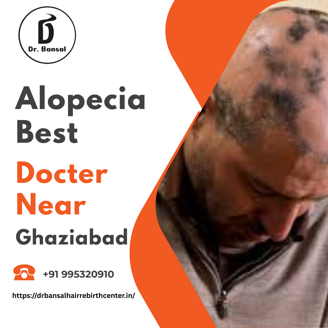 Alopecia Best Docter Near Ghaziabad