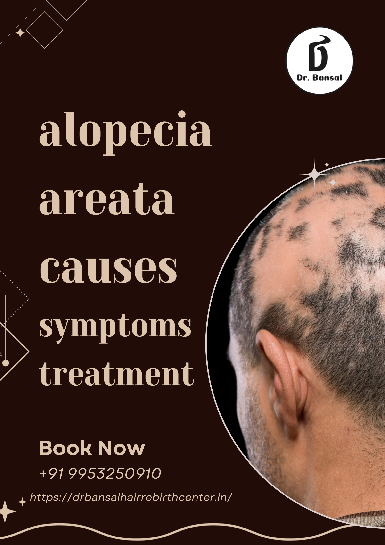 alopecia areata causes symptoms treatment