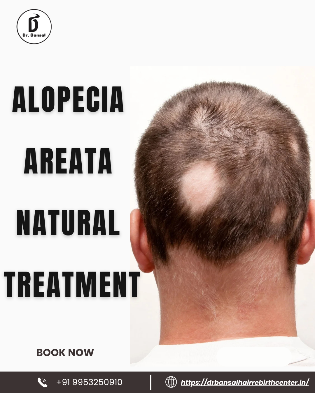 alopecia areata natural treatment 1