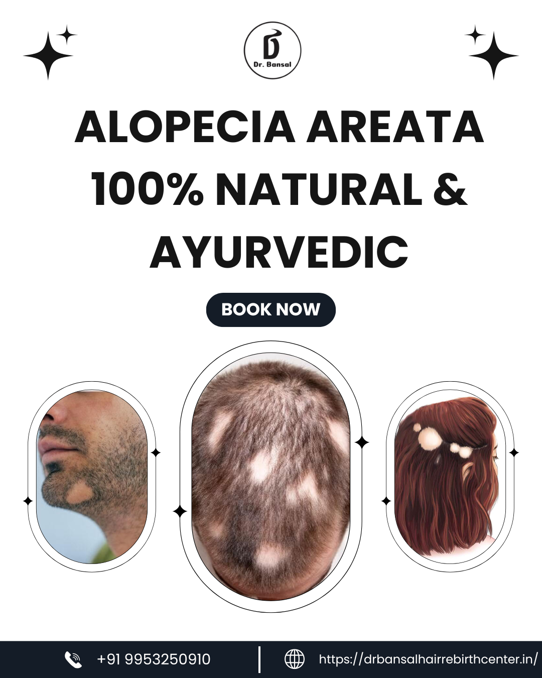 alopecia areata 100% Natural & Ayurvedic 1